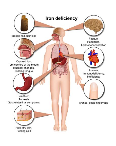 Iron deficiency